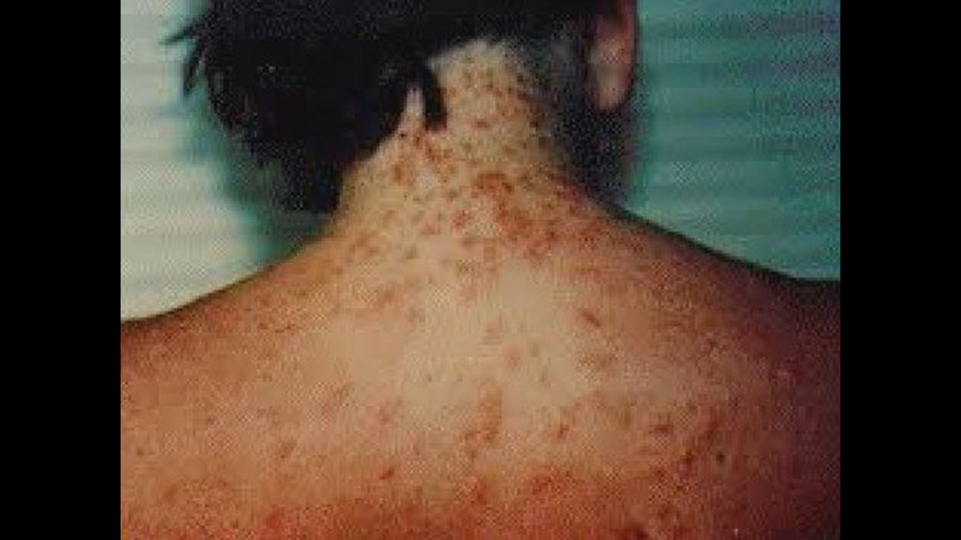 swimmers itch rash swimmers itch rash