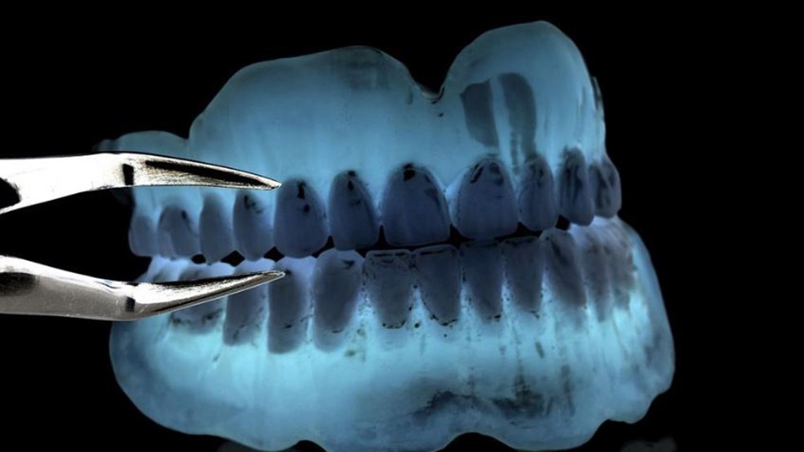 St. Louis dental lab layoffs