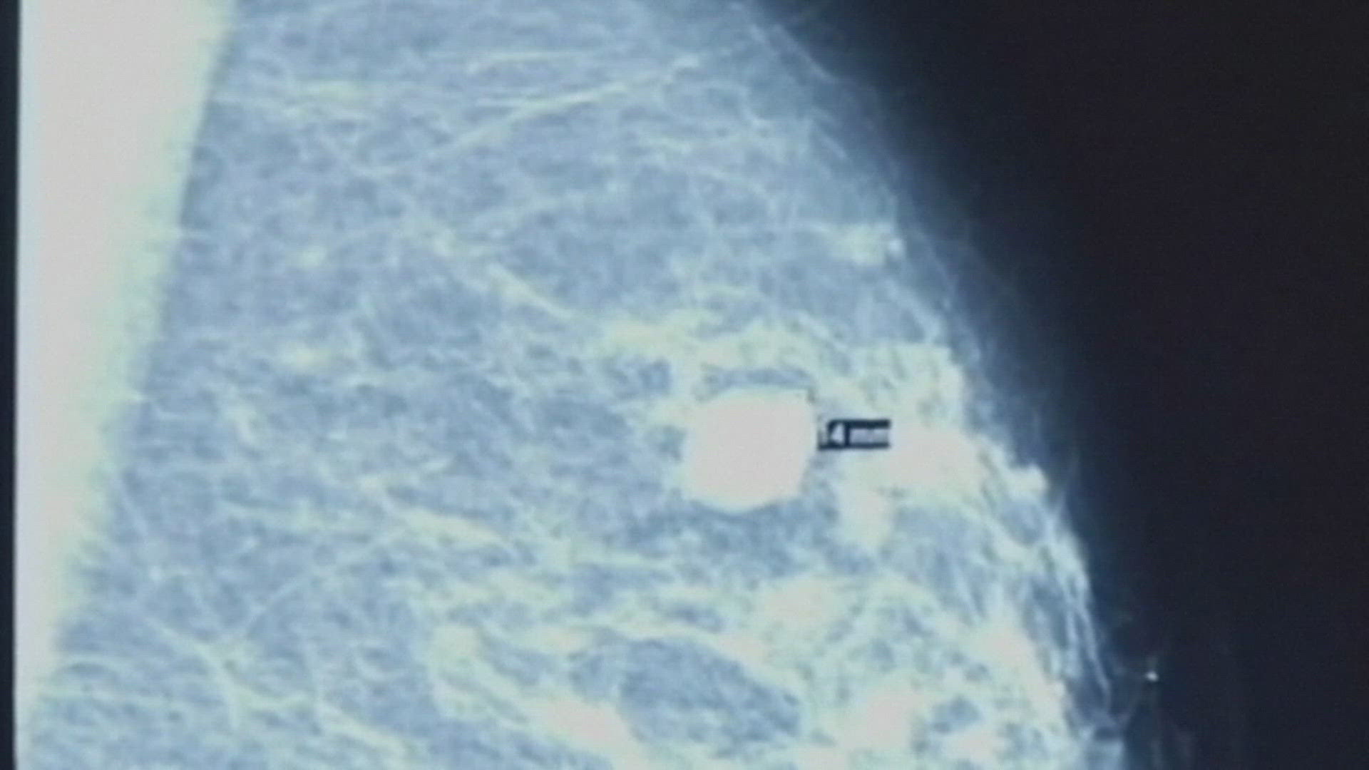 The AI can analyze a mammogram and catch abnormalities missed by the human eye.