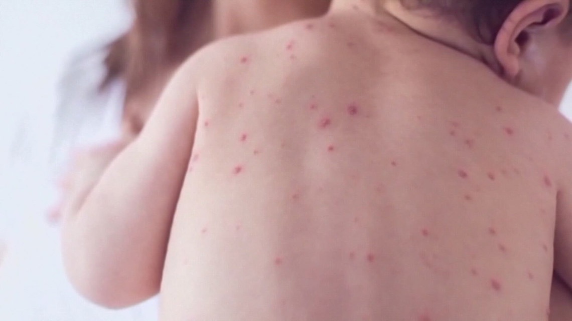 First measles case reported in Maine since 2019