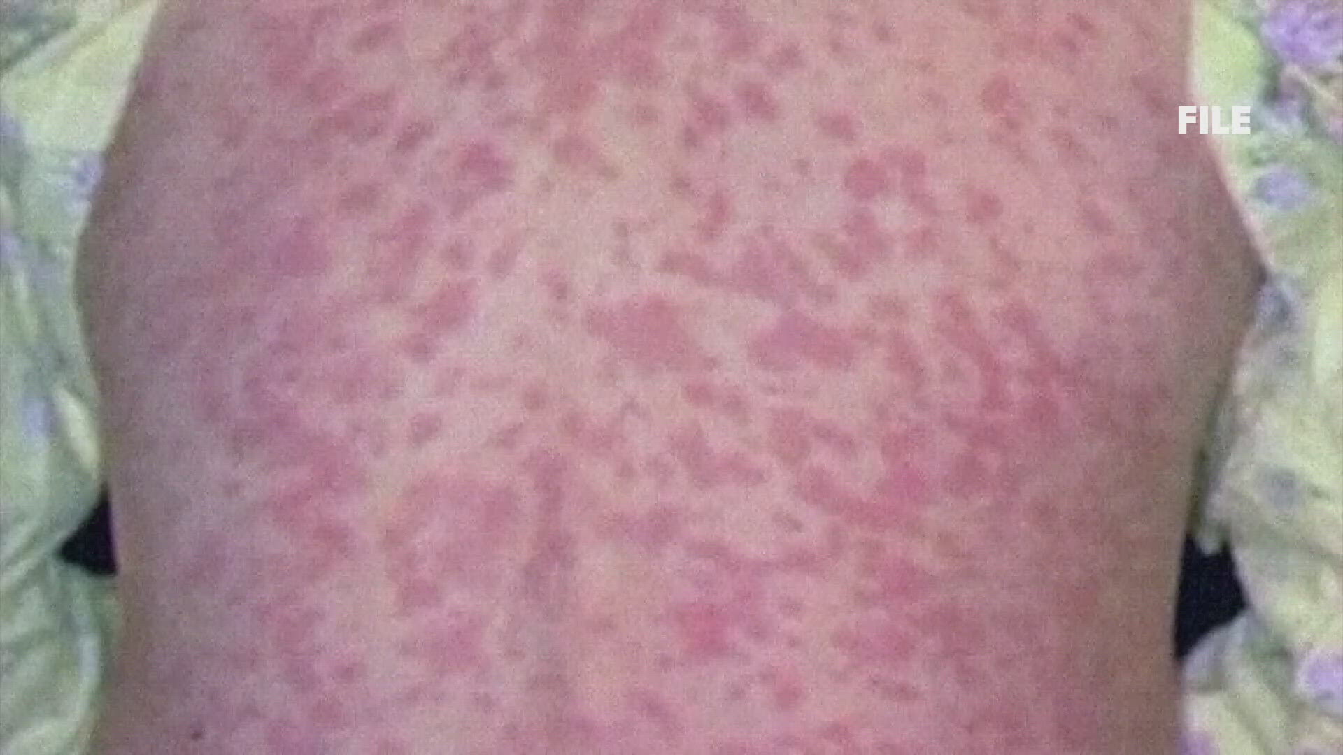 Maine Confirms Sixth Measles Case, Warns of Waterville Exposure