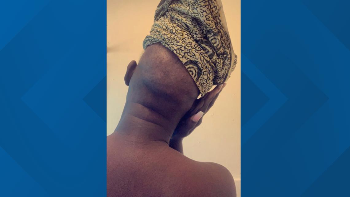 South Sudanese immigrant speaks about stigma of breast cancer - Vimarsana News