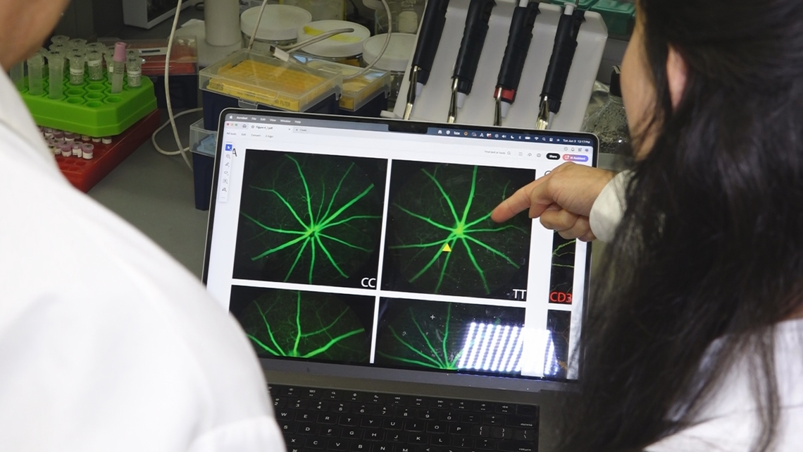 Eye screenings may offer low-cost Alzheimer’s detection
