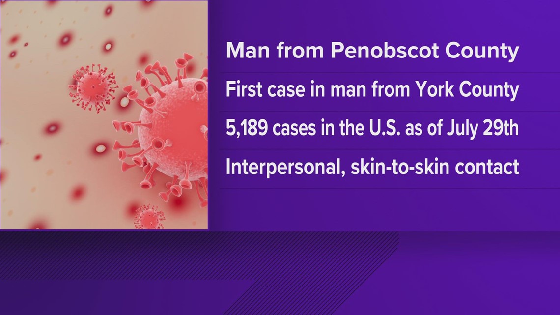 Second monkeypox case confirmed in Maine