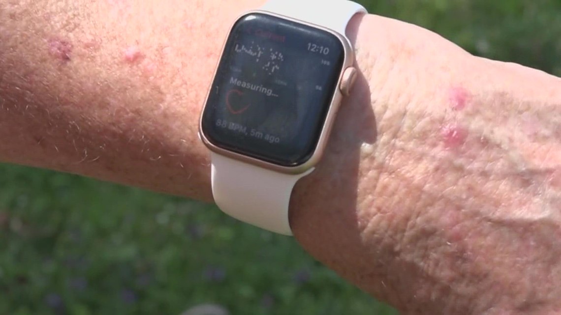 Apple Watch alert leads doctors to life-saving discovery for Solon woman