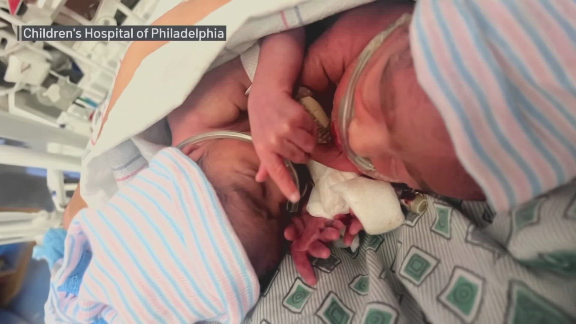 The twins spent 10 months before the surgery, learning how to feed and grow outside the womb. The actual surgery lasted eight hours.