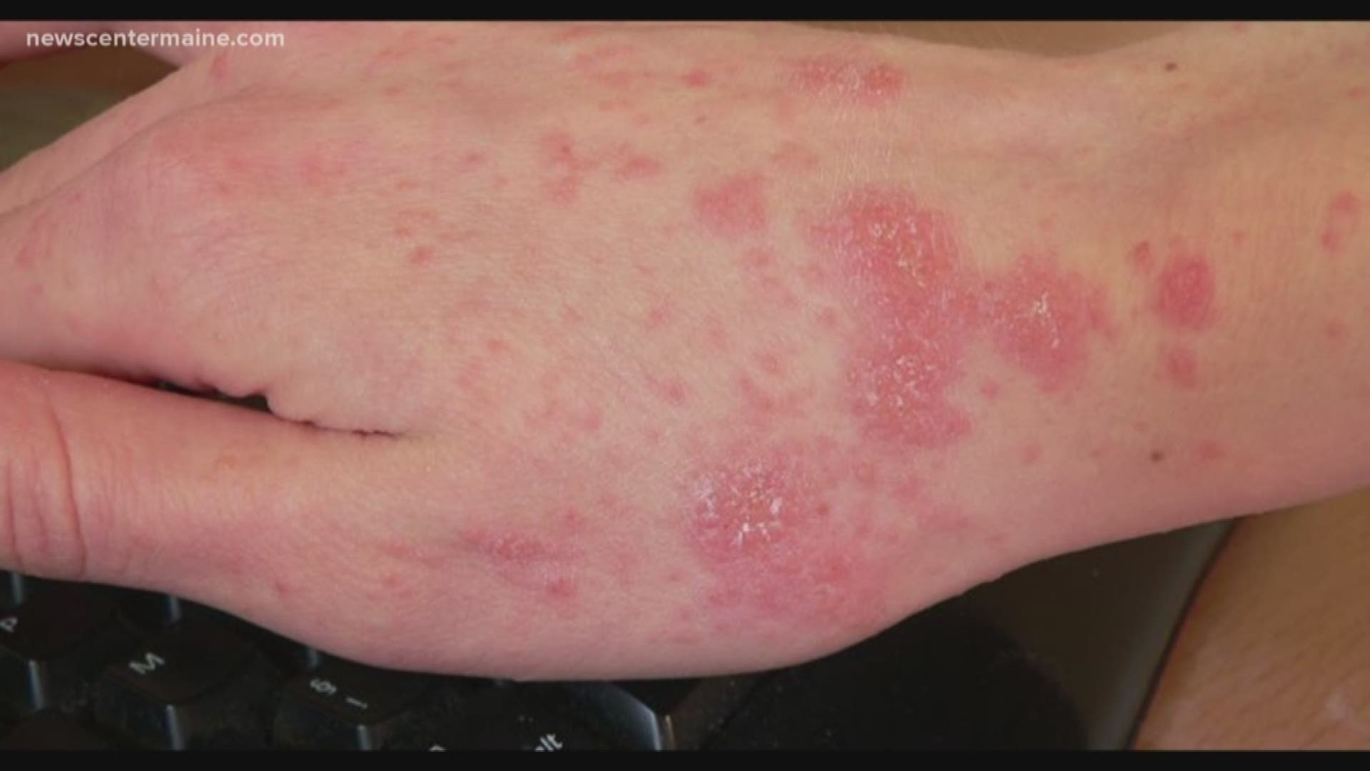 An outbreak of scabies at a skilled nursing facility in Falmouth is infecting not only patients but members of the staff.
