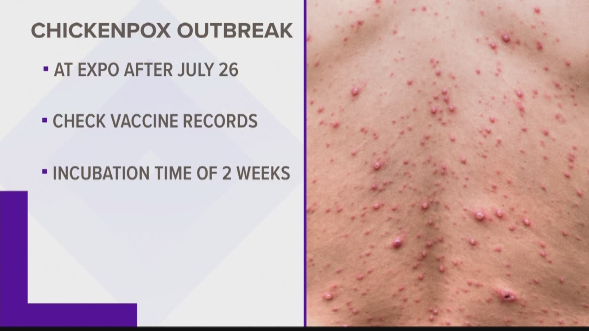 Portland health officials say staff and volunteers at the Portland expo may have been exposed to chickenpox.