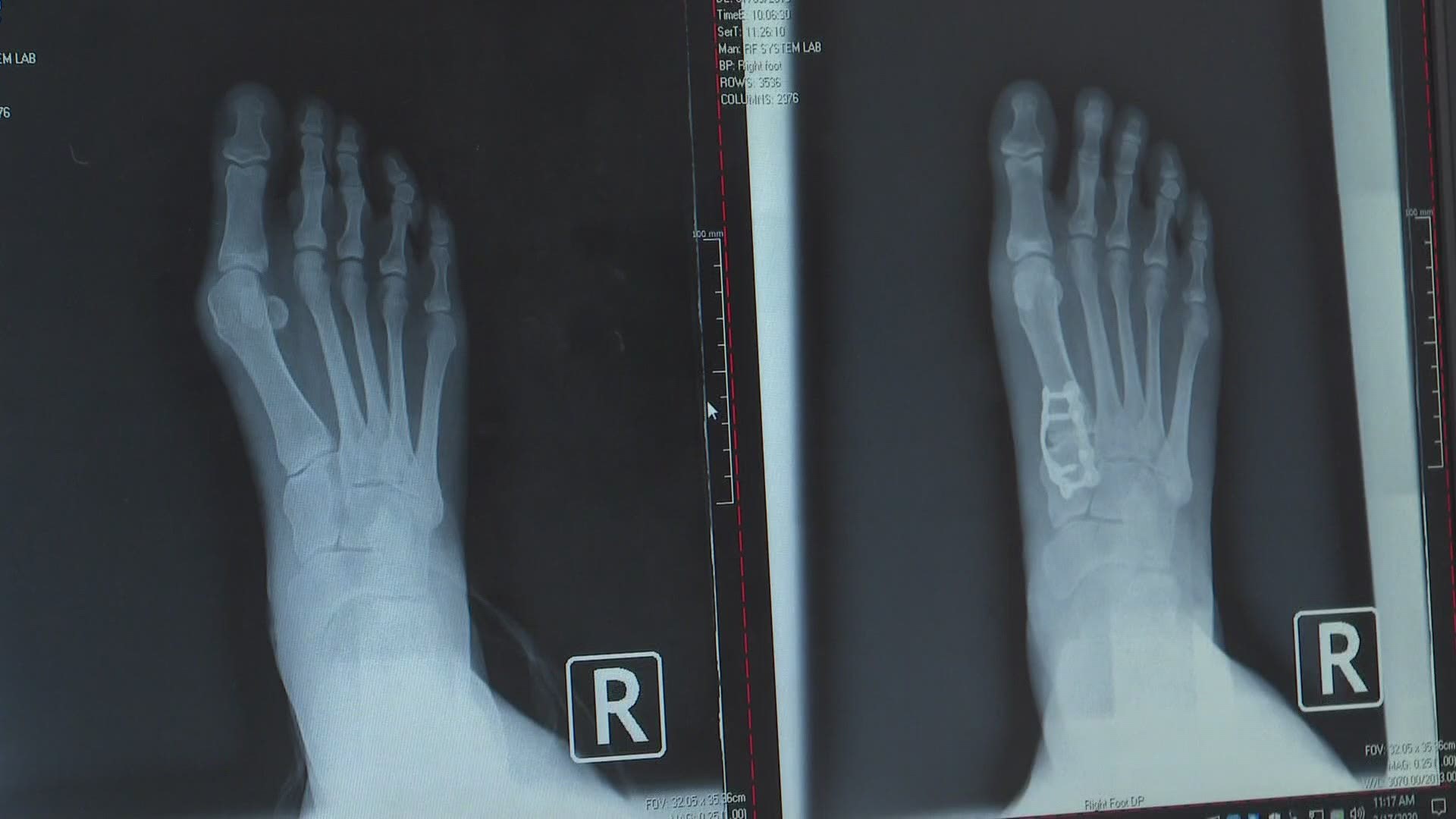 Less invasive bunion surgery brings relief to some patients